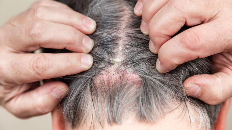 What Makes the Sore Scalp Treatment Most Essential?
